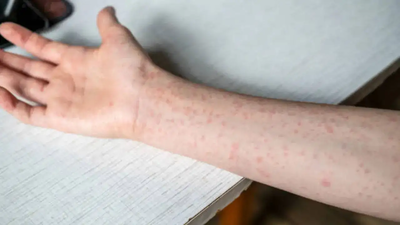 Measles Surge In US: Nearly 500 Cases Confirmed, Texas Worst Affected