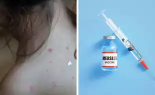 US Grapples With The Largest Measles Outbreak In Decades; Doctors Call For Increased Vaccination