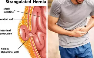 How To Tell If You Have Hernia; 10 Signs You Should Not Ignore
