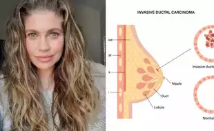 Breast Cancer: What is Ductal Carcinoma In Situ - The Cancer Affecting Actor Danielle Fishel?