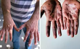 Mpox Virus Reaches Thailand As Clade 1B Strain Now Infects Six Countries; Know The Symptoms To Prevent The Virus