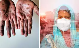 EXPLAINER: How Are Mpox And COVID-19 Different Despite Being Viral Infections