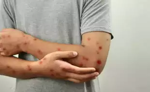 Mpox Virus Outbreak: Expert Debunks Myths Around The Viral Disease