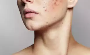 Red Flag Spots On Your Face Which Are Cancer Warnings
