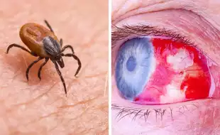 Teen Infected With Deadliest Eye-Bleeding Virus; Know All About Crimean-Congo Hemorrhagic Fever