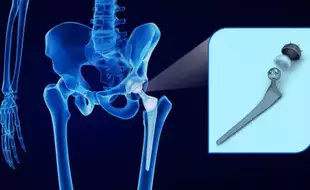 Is Robotic-Assisted Hip Replacement Surgery Safe And Effective? Expert Addresses Common Concerns