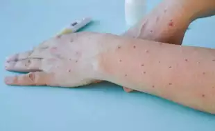 Mpox Strain In India: How COVID-19 Is Increasing Risks