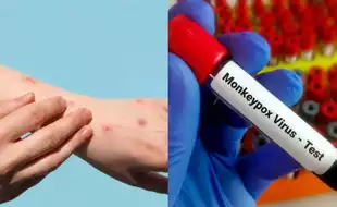 First Mpox Case Reported In Serbia’s Kosovo Region—Here’s What You Need To Know