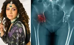 Didn't Want To Live Anymore: Tannaz Irani On Her Battle With Avascular Necrosis; Know All About The Life-Threatening Condition