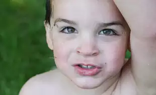 What Is Slapped Cheek Syndrome US CDC Has Issued Warning For?