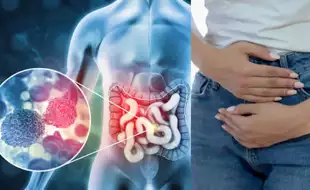 Woman Diagnosed With Stage 3 Colon Cancer at 44; 5 Critical Symptoms She Ignored