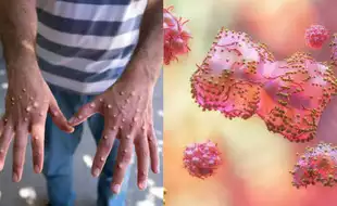 France Confirms First Case Of Clade 1B Mpox; Know The Key Symptoms