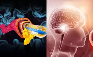 Brain Stents: A Gamechanger In Preventing Major Strokes Are Completely Safe, Say Experts