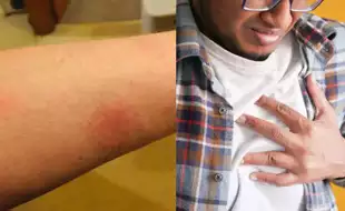 Could Your Lupus Skin Symptoms Be Putting Your Heart Health At Risk? Study Answers
