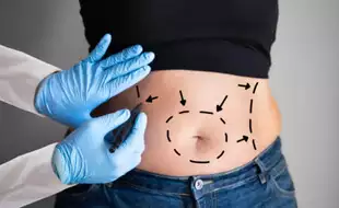 From Loose Skin To Flat Abs: 5 Things You Must Know Before Getting A Tummy Tuck Surgery