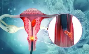 Cervical Cancer: Role of Gender Health In Understanding One of the Deadliest Killers In Oncology
