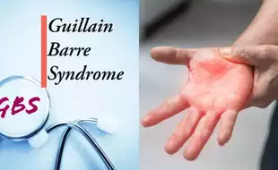 Guillain-Barre Syndrome Cases In Pune: Are Vaccines Or Infections The Cause Of The Rare Nerve Disorder? Expert Weighs In