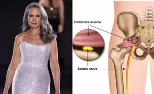 What Is Piriformis Syndrome, A Painful Neuromuscular Condition Andie MacDowell Is Battling? Is It Different From Sciatica?