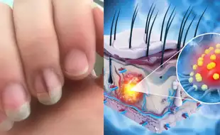 Woman's Unusual Nail Was The First Sign of Stage 4 Terminal Cancer, Since Then Has Returned Thrice; Know How Melanoma Spreads
