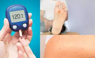 5 Symptoms of Diabetes You Can Spot On Your Skin