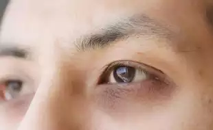 Dark Circles Are Red Flag Symptoms of THIS Potentially Dangerous Condition That Causes Breathlessness