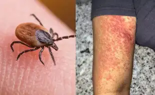 Man Dies of Congo Fever in Gujarat; Are You At Risk? Know the Signs and Symptoms of the Deadly Viral Disease