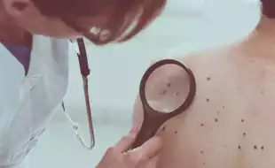 Why Are Skin Cancer Cases Increasing In India? Experts Explain Causes
