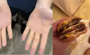 Man Leaks Cholesterol From Body After Following Carnivore Diet; Know All About Xanthelasma, The Condition That Causes It