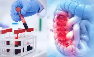 Groundbreaking Bowel Cancer Test Is 90 Percent Accurate At Predicting Disease In Those At High Risk