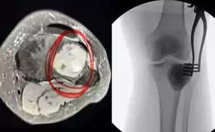 Woman Shares Early Signs of One-in-a-million Tumour That 'Ate Her Bones'; Know All About Osteoclastoma