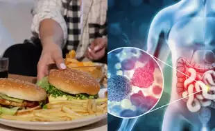 These Everyday Foods May Be Linked To Gastrointestinal Cancer! Expert Warns