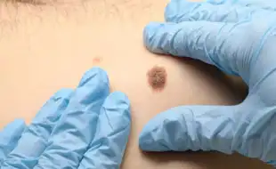 Skin Cancer Warning: 5 Signs You Should NEVER Ignore!