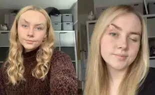 Woman Has To Glue Her Eyelids To Keep Them Open Due To An Ultra Rare Condition; Know What It Is