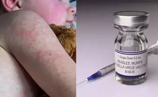 US Reports New Cases of Measles in Texas and New Mexico; This Is Why The Numbers Are Rising