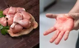 Can Raw Chicken Give You Paralysis? Here's How Guillain-Barre Syndrome Gets Triggered