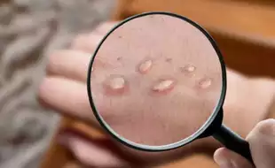 UAE, New York Confirm First Cases of Mpox New Strain; Know Symptoms of This Highly Contagious Viral Infection