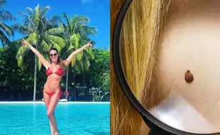 British Model Danielle Lloyd Reveals Skin Cancer Diagnosis; Lists Early Signs of Melanoma