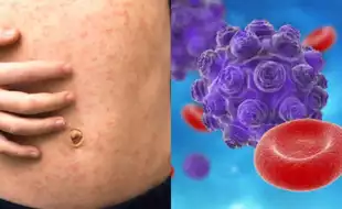Texas Measles Outbreak Nears 100 Cases, Raising Concerns About Undetected Spread