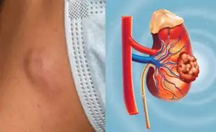 THIS Symptom In Your Neck May Mean Kidney Cancer, Warn Doctors; Know Signs You Must Not Ignore