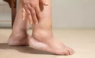 Unexplained Swelling Can Be A Cause Of Concern! It Is Linked To THIS Serious Condition