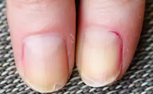 Is the Peeling Skin Around Your Nails Painful? It Could Be a Sign of Vitamin Deficiency