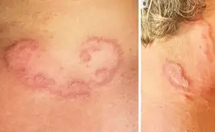 Teenager Complained of Neck Rashes Only to Be Diagnosed with Worms Squirming Inside Him; How Can You Get Hookworms?