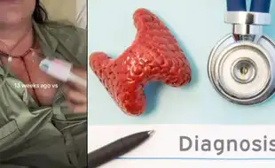 Woman With Chest Pains Dismissed As Anxiety Gets Diagnosed With 204 Cancerous Lumps Due To Medullary Thyroid Cancer; What Is It?