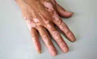 Consuming Fish with Dairy Causes Skin Diseases like Vitiligo: Myth or a Fact?