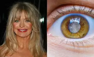 Goldie Hawn Shares She Has Cataract and Can’t Read the Oscar Autocue; Many Wonder Why! Possible Cases Where Cataract Surgery Can Be Difficult