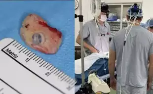 Doctors Implant A Man's Tooth In His Eye To Restore Sight In A Rare Surgery; Know All About This Jaw-Dropping Procedure