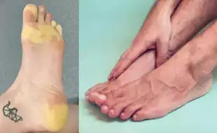 Woman's Feet Turn Yellow Due to High-level Stress Caused by a Debilitating Condition; Know All About Raynaud's Syndrome