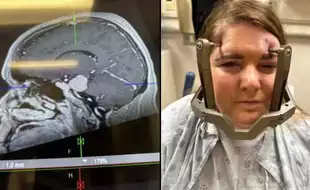 Woman Who Thought Tingling In Her Cheek Was Stress Diagnosed With Meningioma, A Brain Tumour; Know the Symptoms
