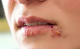 New Study Shows How Herpes Virus ‘Hijacks’ The Immune System To Survive