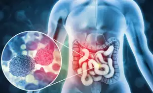 Colorectal Cancer Patients Are Getting Younger, Warns Surgeon; Two Symptoms That Are Mostly Ignored